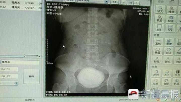 女子膀胱长出铅球大结石 专家：在医学界至今看到那么大实属罕见